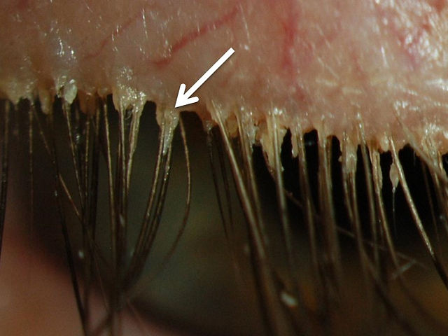 Billede af en mikroskopisk visning af demodex-mider. Billedet viser de små parasitiske mider, der er en del af den naturlige mikrobiota på menneskers hud, herunder området omkring øjenvipperne. Demodex-miderne vises som små, spindellignende væsener, der lever i hårsækkene og kan være forbundet med øjenrelaterede problemer som øjenirritation, kløe og inflammation. Billedet illustrerer demodex-miderne og deres tilstedeværelse i øjenområdet