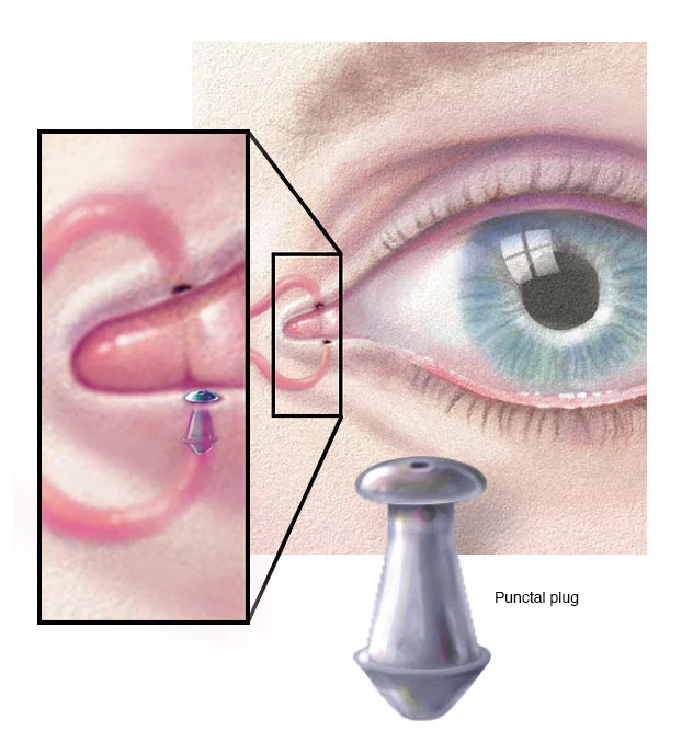 Pinctal plugs behandling af tørre øjne